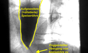 Illustrationsfoto: Erweiterte Speiseröhre