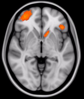 Bild zeigt funktionelle Aktivierung des Frontalkortex im MRT.