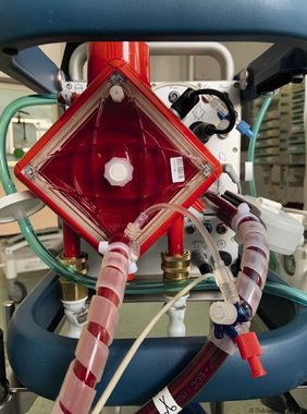 Extrakorporale Membranoxygenierung (ECMO)