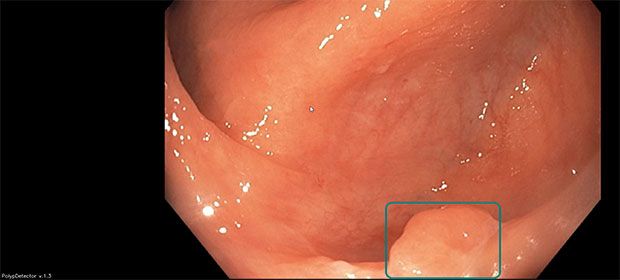 Example of the interface An example of the interface, displaying recording information in the upper left corner, the AI version in the lower left corner, and the endoscopic image with AI boundary boxes in the center.