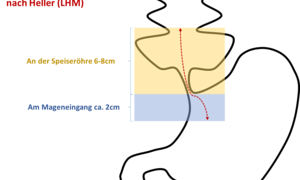 Illustrationsfoto: Ausmaß der Myotomie