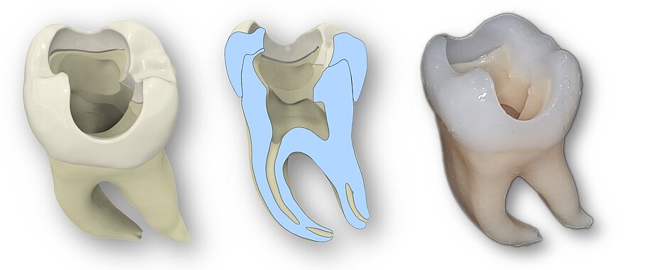 Konstruktion eines Übungszahnes 2 Ansichten eines 3D-gedruckten Zahnes und eines Querschnitts