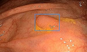 Image: An example of the way the CADe system highlights a polyp.