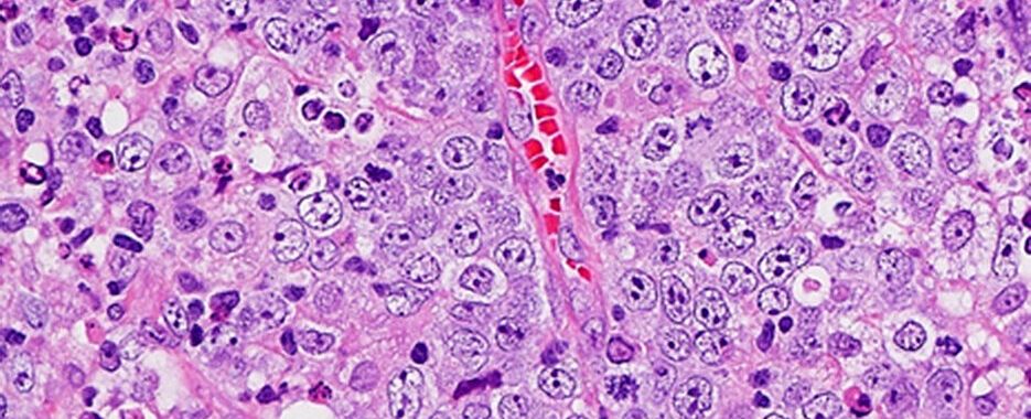 Krebszellen eines diffusen großzelligen B-Zell-Lymphoms unter dem Mikroskop.