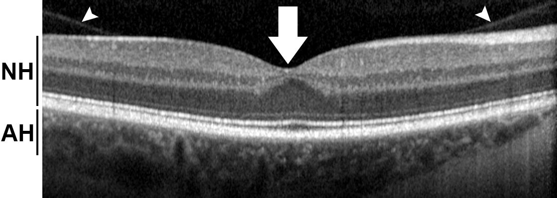 Röntgenbild: Optische Kohärenztomographie