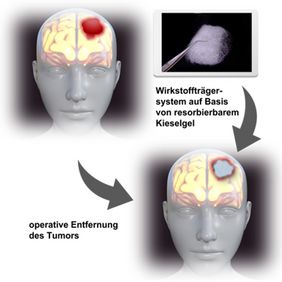 Die Grafik zeigt das Konzept vom GlioGel 
