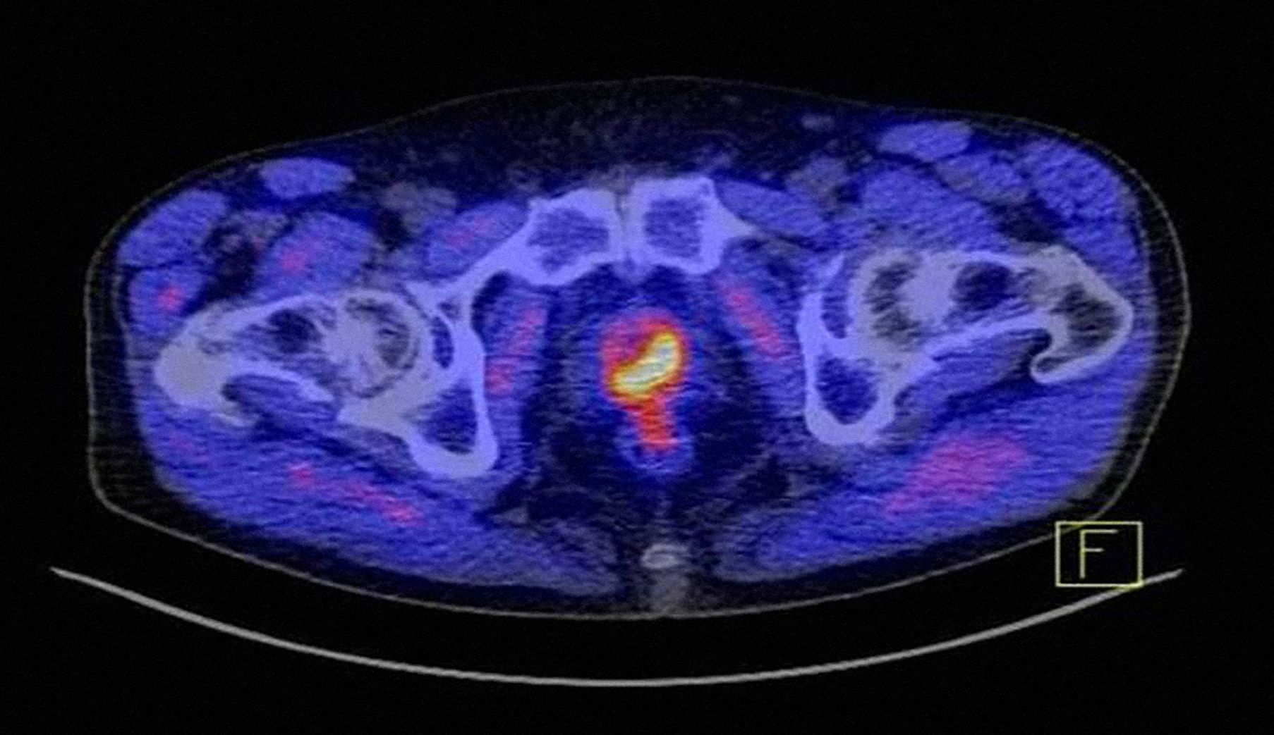 Das Bild zeigt, wie markant ein Prostatakarzinom unter Zuhilfenahme des Tracers PSMA im PET-CT als gelb-rotes Objekt dargestellt wird.
