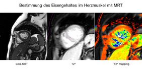 Magnetresonanztomogramm - klassisches CINE-MRT und T2-Mapping 