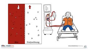 Screenshot vom Patientenfilm: Kann eine Standard-Dialysat-Natriumkonzentration von 137 mmol/l verglichen mit 140 mmol/l kardiovaskuläre Ereignisse und Todesfälle bei erwachsenen Hämodialysepatientinnen und -patienten verringern?