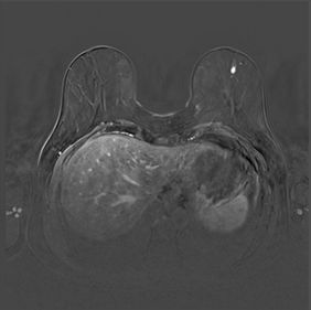 MRT-Bild eines 8 Millimeter großen Mammakarzinoms