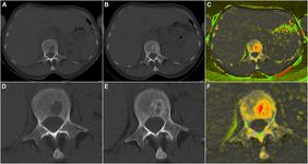 Computertomografische Aufnahmen einer Läsion vor und nach Therapie.