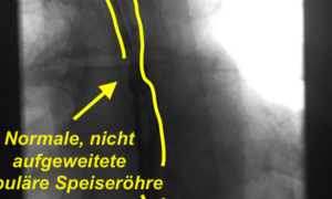 Illustrationsfoto: Normalbefund Speiseröhre