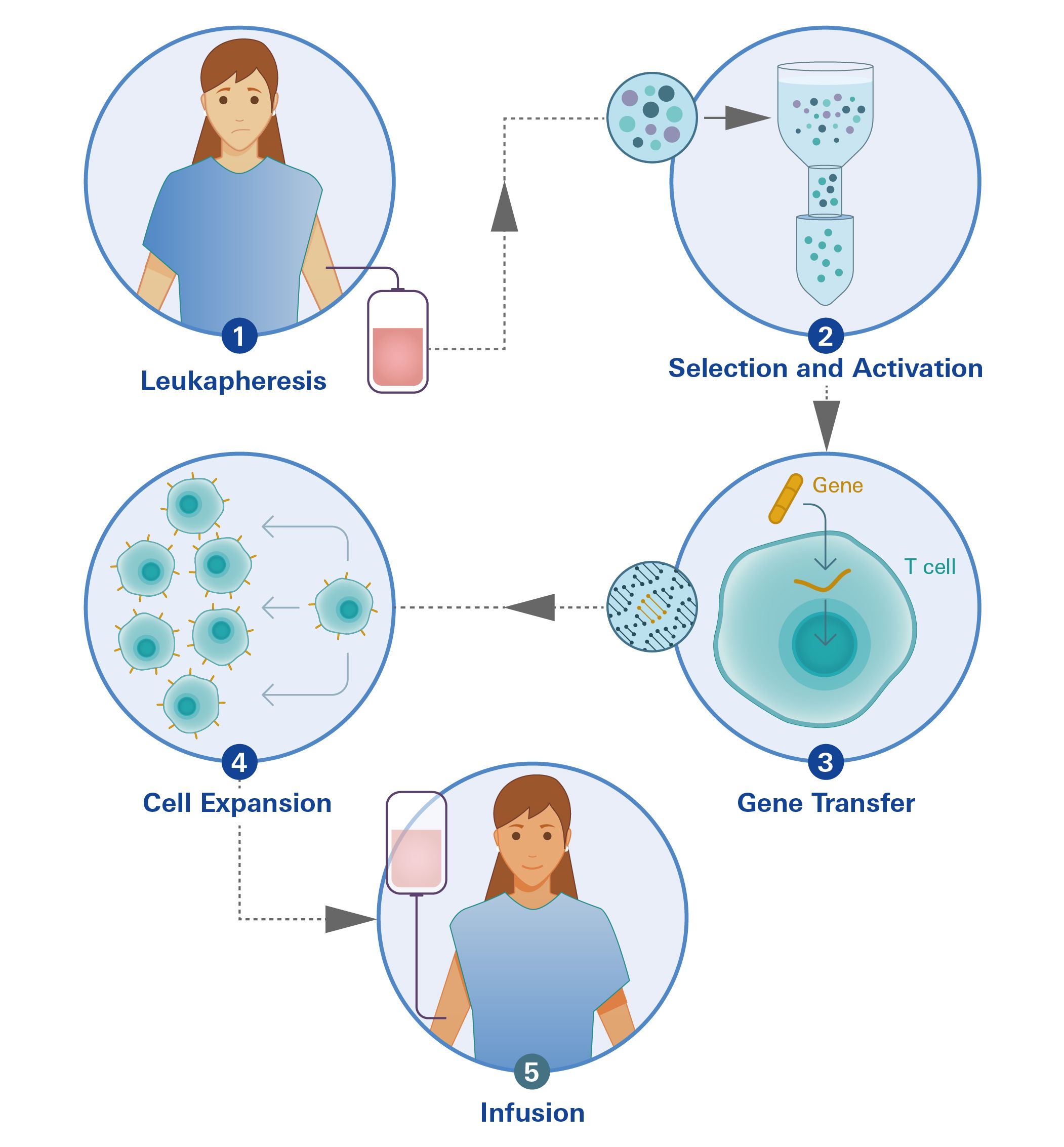 Illustration des klinischen Anwendungsprozesses von CAR-T-Zellen: Entnahme der Leukozyten (Leukapherese), Selektion und Aktivierung, Gentransfer, Zellexpansion und Infusion.