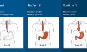 Illustrationsfoto: Stadien I-III