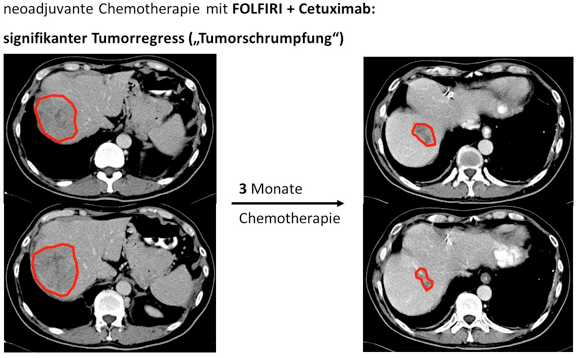 CT-Scan Veränderung nach drei Monaten Chemotherapie
