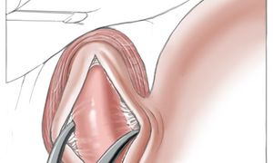 Illustrationsfoto: Schematische Darstellung einer Heller-Myotomie.