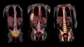 Das Bild zeigt auf drei PET-Bildern Tumorherde an unterschiedlichen Stellen des Skeletts.
