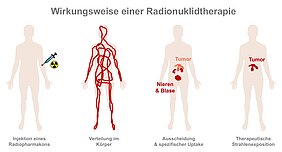 Hier wird an vier Figuren beschrieben, wie die Radionuklidtherapie funktioniert. Injektion eines Radiopharmakons, Verteilung im Körper, Ausscheidung über Niere und Blase und spezifischer Uptake im Tumor, sowie therapeutische Strahlenexposition (nur der Tumor leuchtet im Körper). 