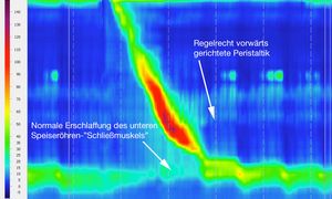 Illustrationsfoto Normalbefund HRM