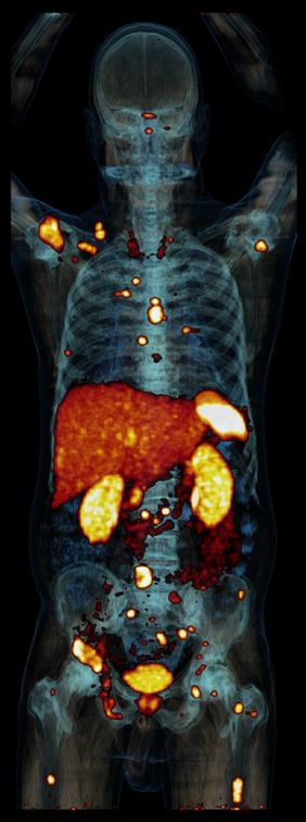 Die PET/CT-Aufnahme zeigt Anreicherung des Tracers 