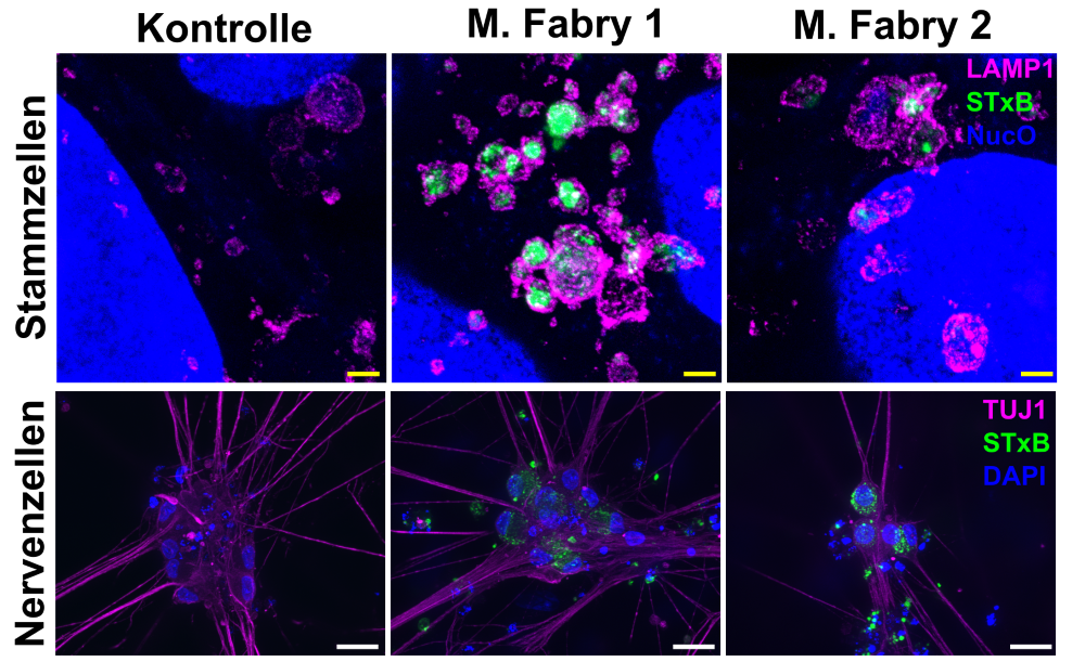Abbildung: Sphingolipidablagerungen in Stammzellen und Nervenzellen