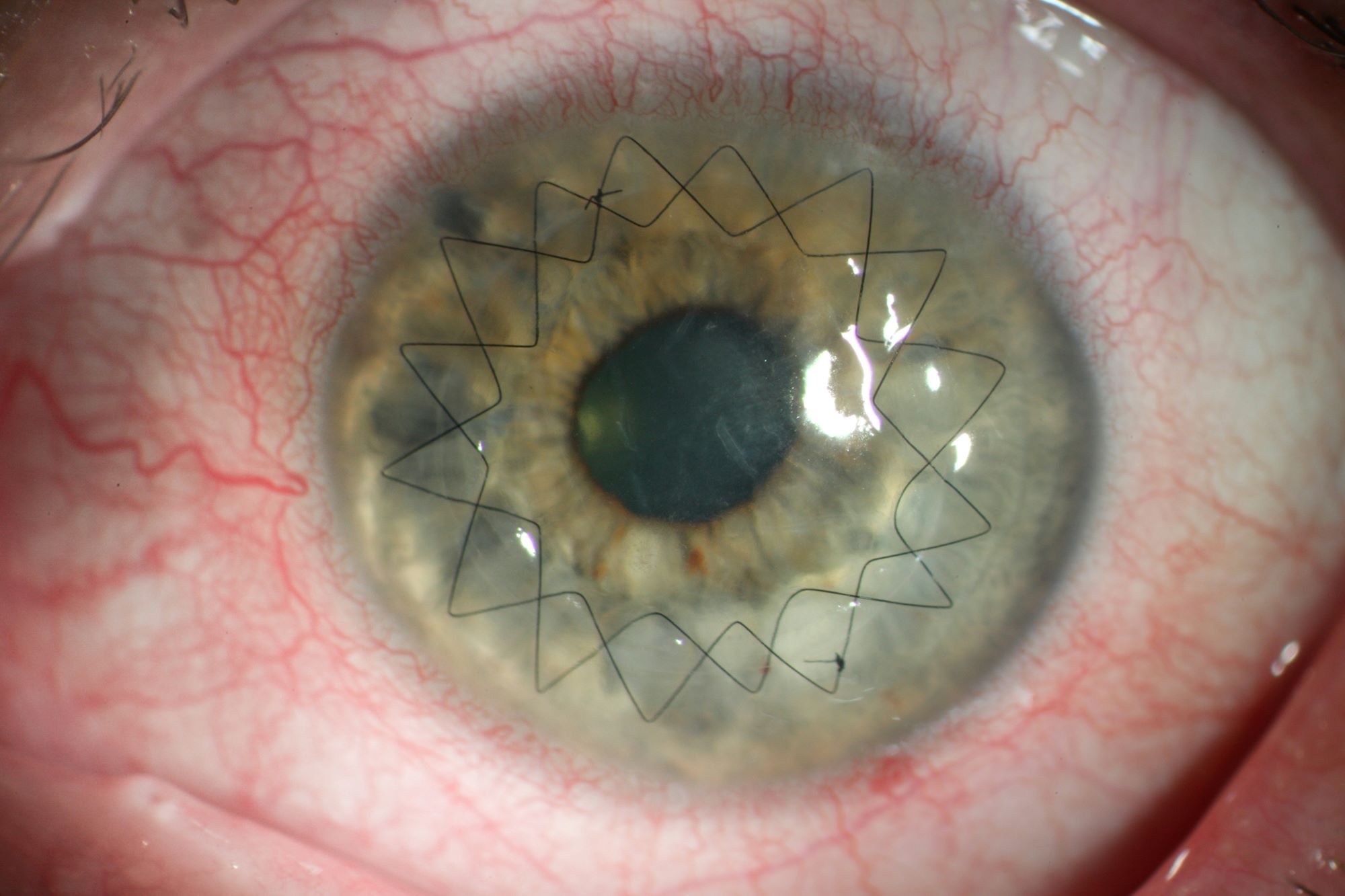 Nahaufnahme eines Auges, die Nähte, mit denen die Hornhaut befestigt wurde, sind deutlich zu sehen. 