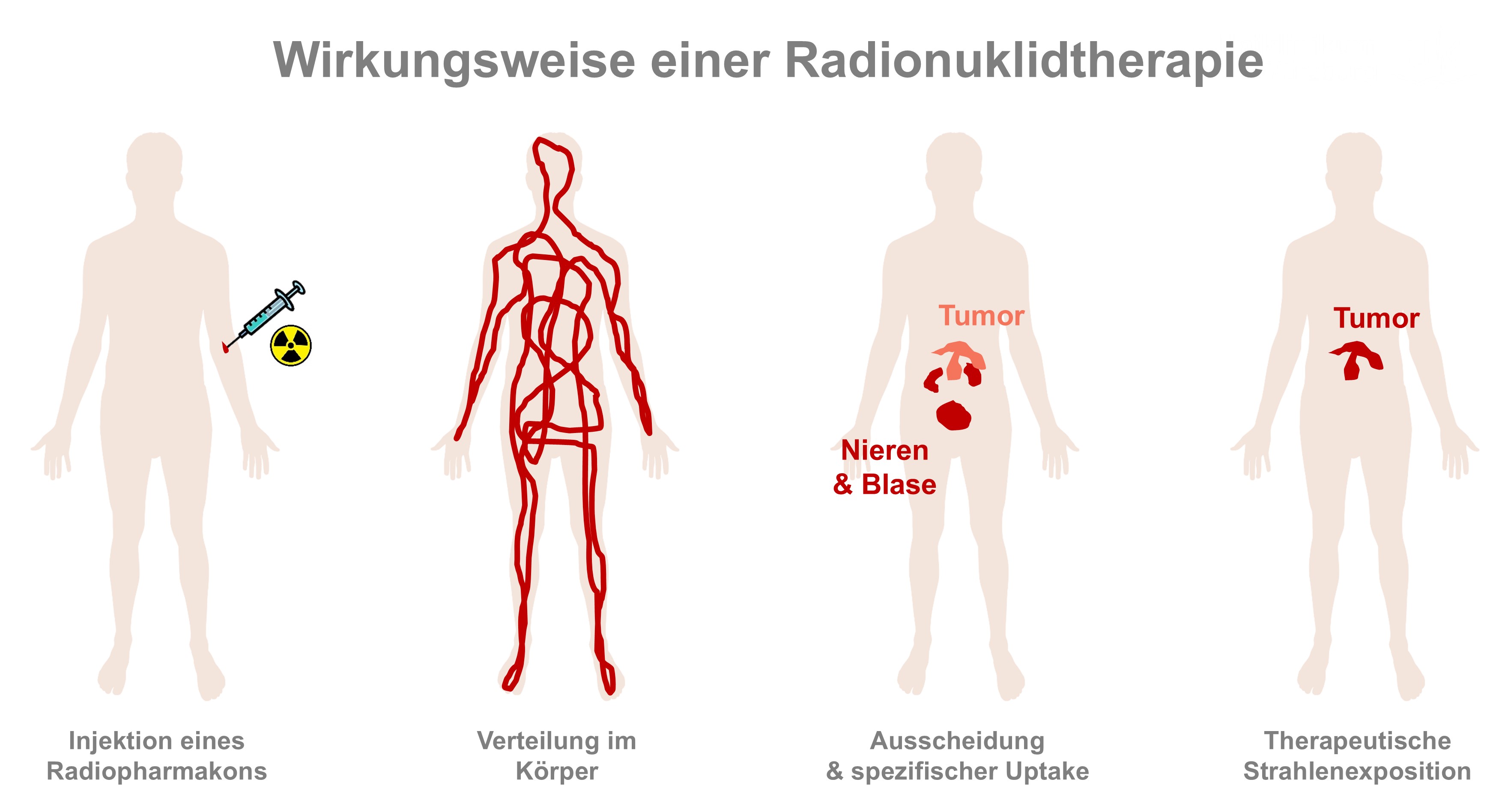 Hier wird an vier Figuren beschrieben, wie die Radionuklidtherapie funktioniert. Injektion eines Radiopharmakons, Verteilung im Körper, Ausscheidung über Niere und Blase und spezifischer Uptake im Tumor, sowie therapeutische Strahlenexposition (nur der Tumor leuchtet im Körper). 