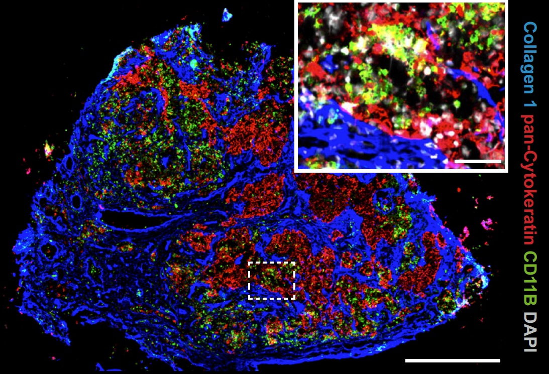 Immunfluoreszenzbild einer Lymphknotenmetastase Immunfluoreszenzaufnahme einer Lymphknotenmetastase. Deutlich erkennbar ist die enge räumliche Interaktion von Tumorzellen, fibroblastischen Retikulumzellen und myeloiden Zellen. Grün markiert sind CD11B-positive myeloide Zellen, rot Pan-Cytokeratin-positive Brustkrebszellen (epithelialen Ursprungs), und blau Kollagen I, das von fibroblastischen Retikulumzellen gebildet wird. Maßstabsbalken: 500 µm, Inlay: 30 µm.