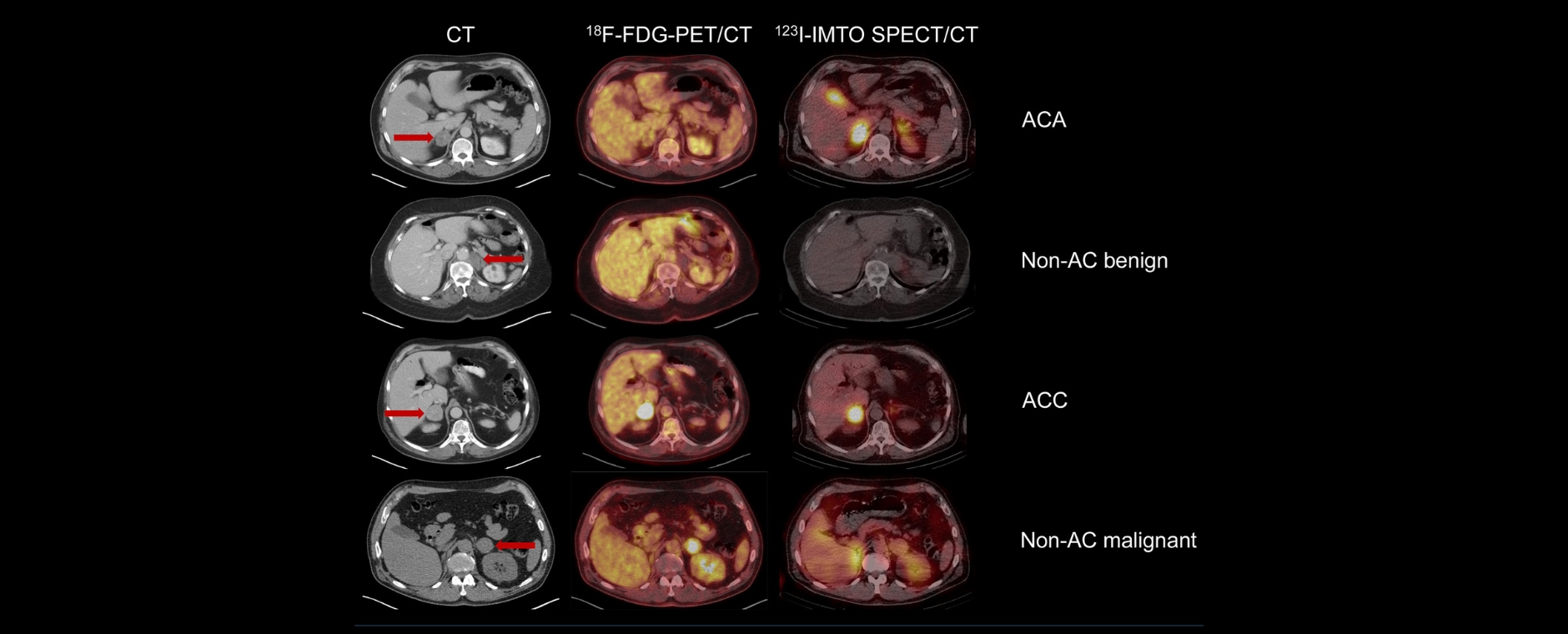 Endokrinologie - CT verschiedene Computertomografische Aufnahmen von Nebennierentumoren