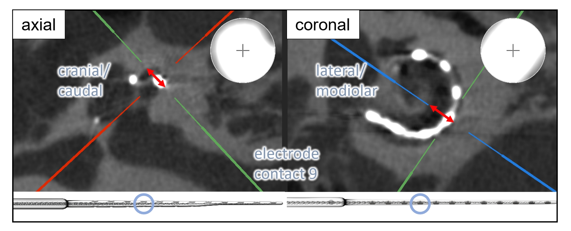 HNO electrode contact view Veranschaulichung der Ausrichtung der Elektrodenkontaktansicht am Beispiel des Elektrodenkontakts C9. Nach der Bestimmung der Mittelpunktsposition des Elektrodenkontakts wird die Sagittalebene in der koronalen Ansicht auf den Modiolus gedreht. Die koronale Ebene wird dann parallel zur basalen Drehung in der axialen Ansicht ausgerichtet. Die Bildgebung erfolgte mit sekundären Rekonstruktionen von Flat-Panel-Volumen-CT (fpVCTSECO; Schichtdicke: 99 μm); die Positionskontrolle wurde mit der OTOPLAN®-Software durchgeführt.