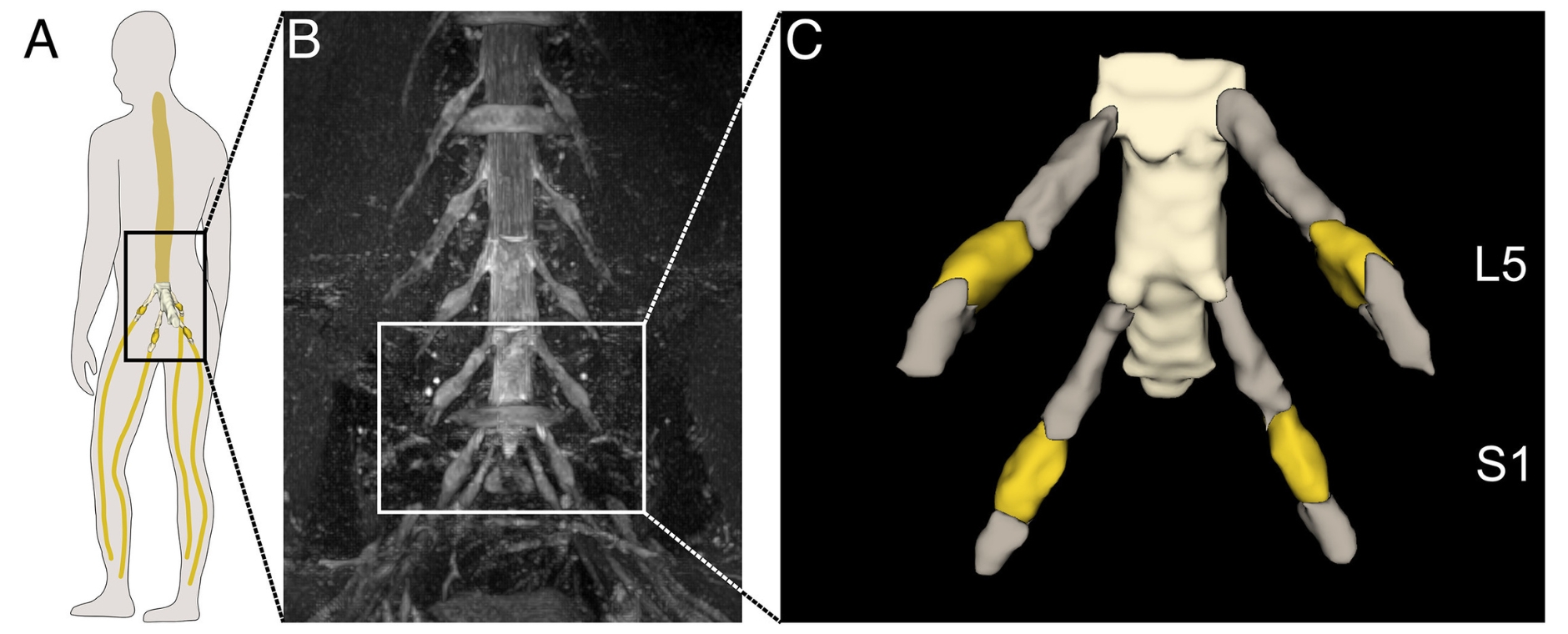 Neuroradiologie 3 Bilder aus der Studie: Grafik vom Menschen mit Fokus auf Lendenwirbel 5 und Steißbein, MRT-Aufnahme und 3D-Bild